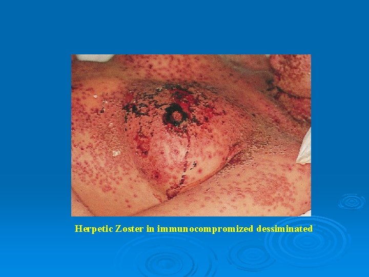 Herpetic Zoster in immunocompromized dessiminated 