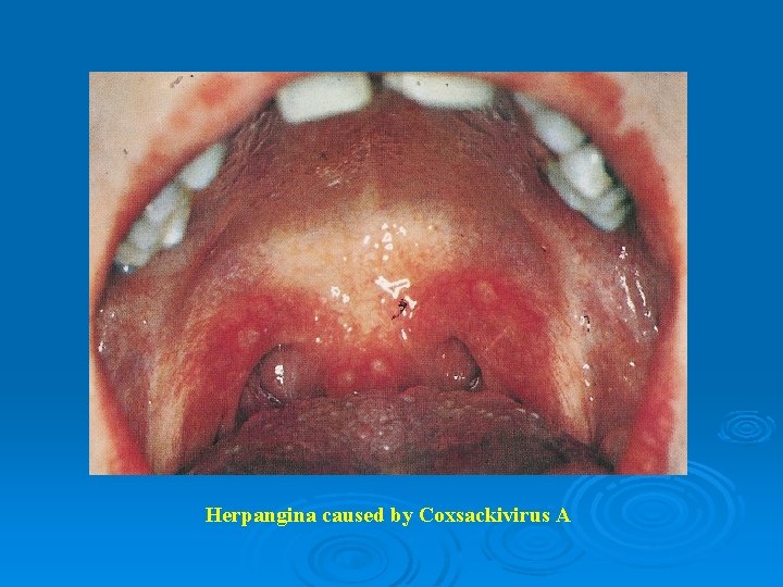 Herpangina caused by Coxsackivirus A 