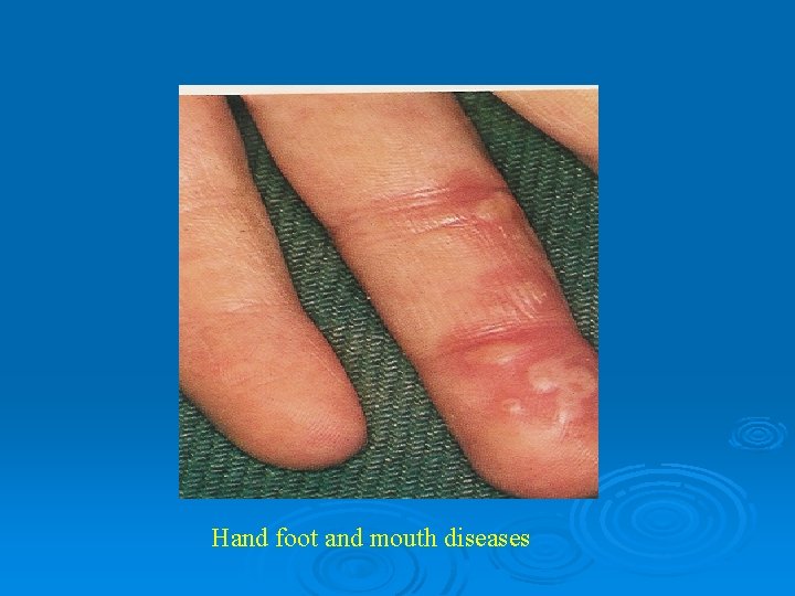 Hand foot and mouth diseases 