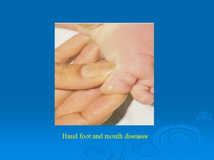 Hand foot and mouth diseases 