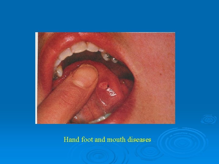 Hand foot and mouth diseases 