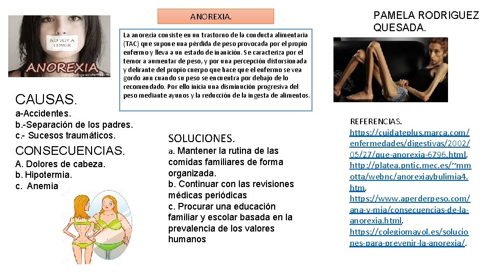 ANOREXIA. CAUSAS. La anorexia consiste en un trastorno de la conducta alimentaria (TAC) que