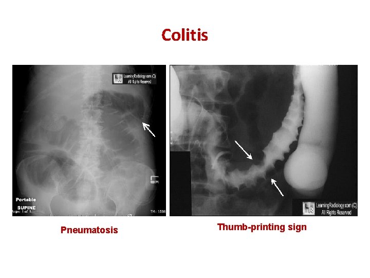 Colitis Pneumatosis Thumb-printing sign 