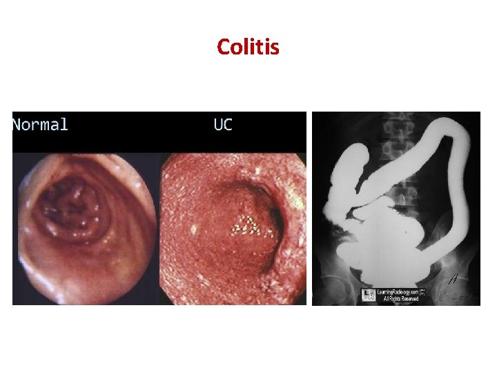 Colitis 