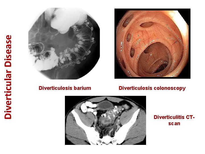 Diverticular Disease Diverticulosis barium Diverticulosis colonoscopy Diverticulitis CTscan 