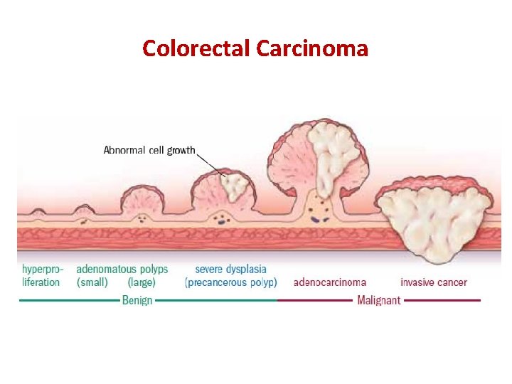 Colorectal Carcinoma 