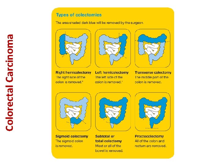 Colorectal Carcinoma 