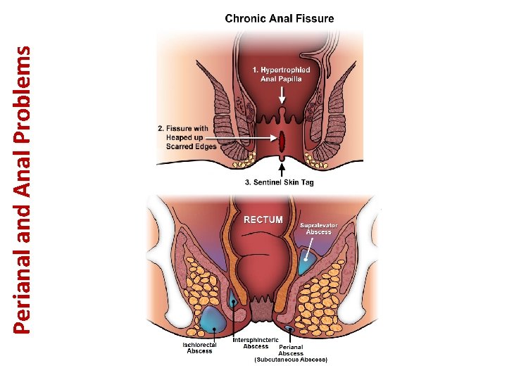 Perianal and Anal Problems 