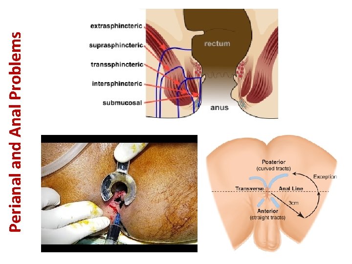 Perianal and Anal Problems 