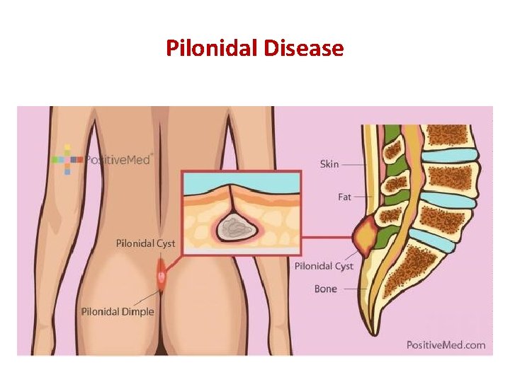 Pilonidal Disease 