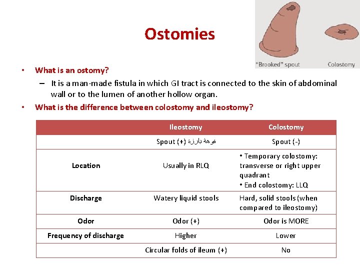 Ostomies • • What is an ostomy? – It is a man-made fistula in