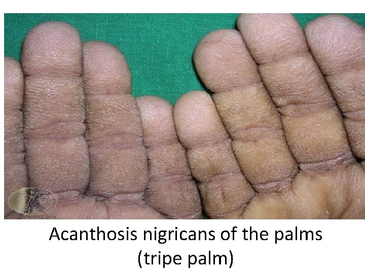 Acanthosis nigricans of the palms (tripe palm) 
