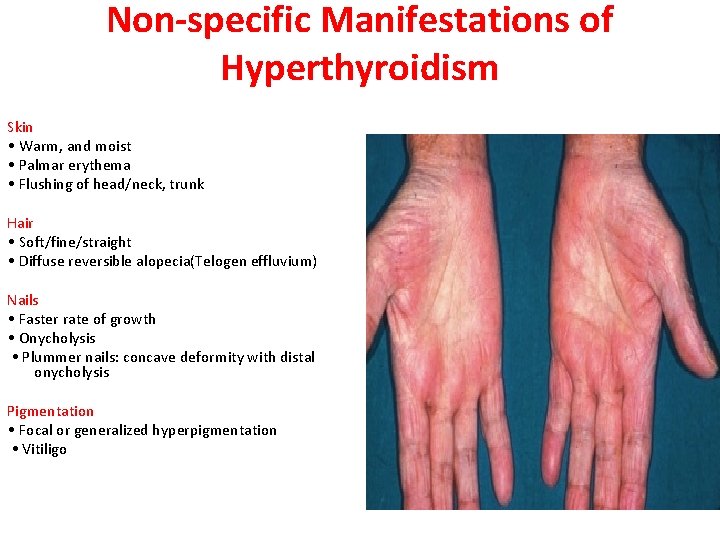 Non-specific Manifestations of Hyperthyroidism Skin • Warm, and moist • Palmar erythema • Flushing