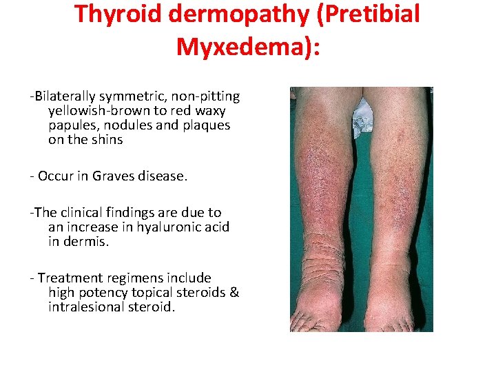 Thyroid dermopathy (Pretibial Myxedema): -Bilaterally symmetric, non-pitting yellowish-brown to red waxy papules, nodules and