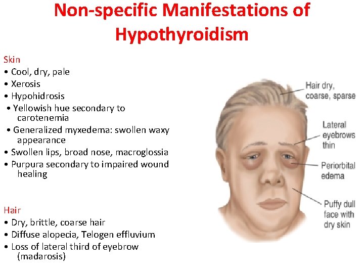 Non-specific Manifestations of Hypothyroidism Skin • Cool, dry, pale • Xerosis • Hypohidrosis •