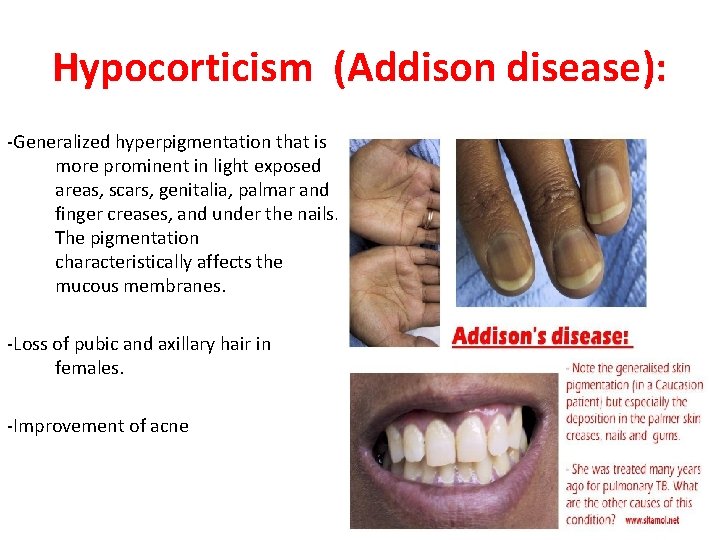 Hypocorticism (Addison disease): -Generalized hyperpigmentation that is more prominent in light exposed areas, scars,