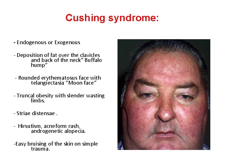 Cushing syndrome: - Endogenous or Exogenous - Deposition of fat over the clavicles and