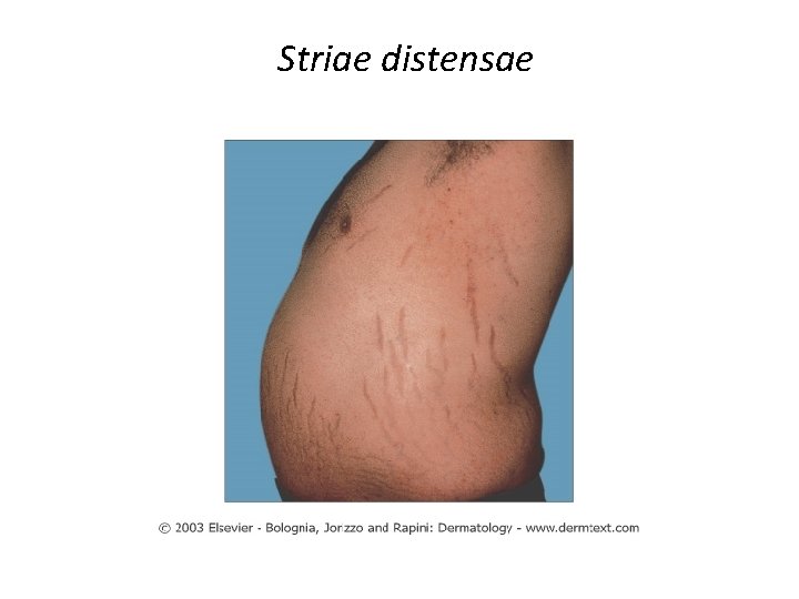 Striae distensae 