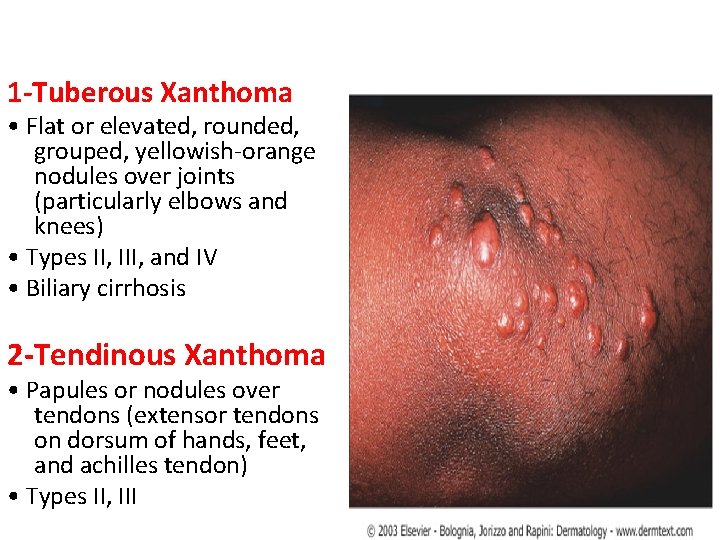 1 -Tuberous Xanthoma • Flat or elevated, rounded, grouped, yellowish-orange nodules over joints (particularly