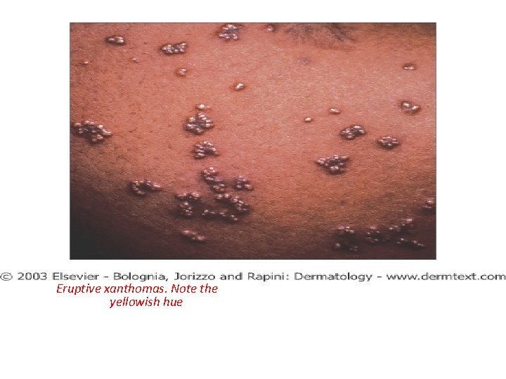 Eruptive xanthomas. Note the yellowish hue 