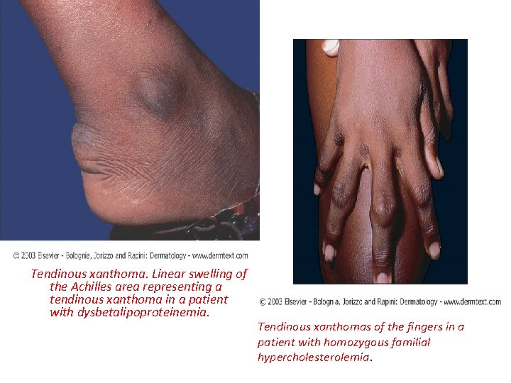 Tendinous xanthoma. Linear swelling of the Achilles area representing a tendinous xanthoma in a