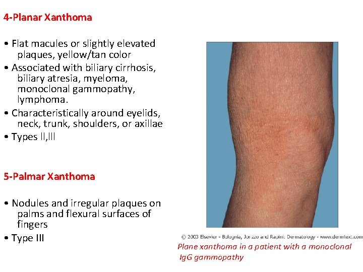 4 -Planar Xanthoma • Flat macules or slightly elevated plaques, yellow/tan color • Associated