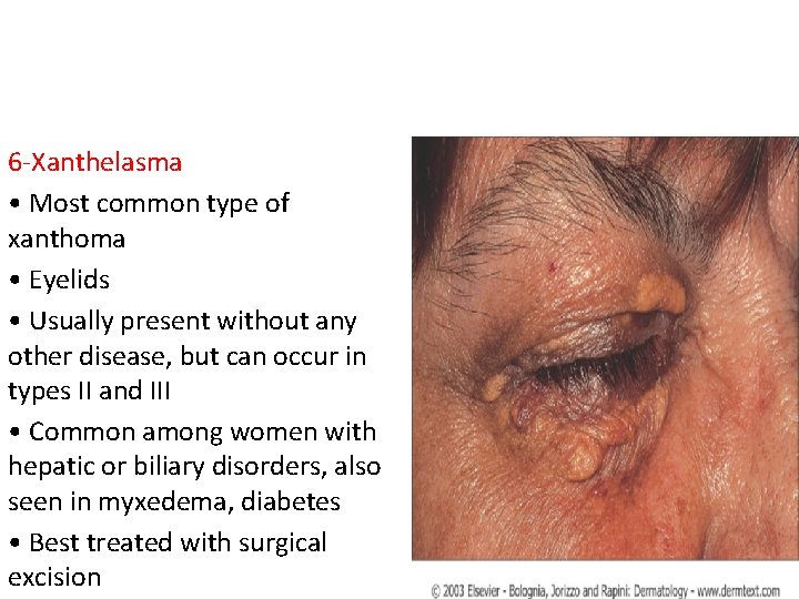 6 -Xanthelasma • Most common type of xanthoma • Eyelids • Usually present without