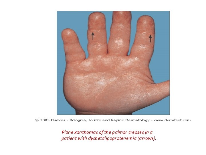 Plane xanthomas of the palmar creases in a patient with dysbetalipoprotenemia (arrows). 