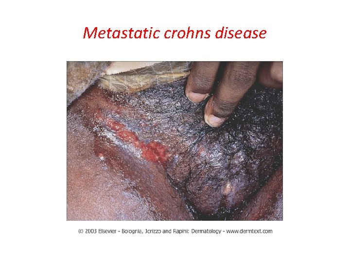 Metastatic crohns disease 