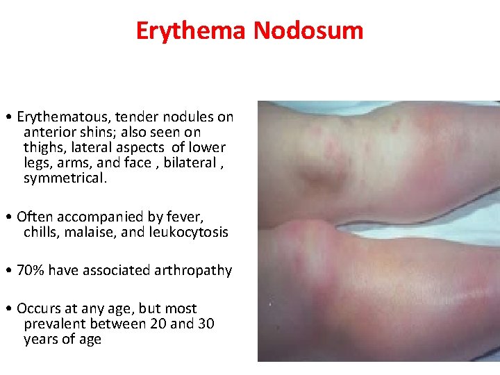 Erythema Nodosum • Erythematous, tender nodules on anterior shins; also seen on thighs, lateral