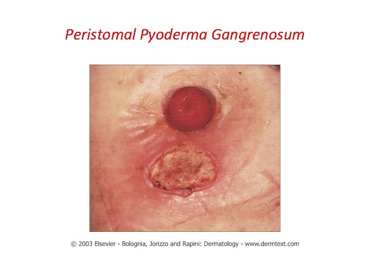 Peristomal Pyoderma Gangrenosum 