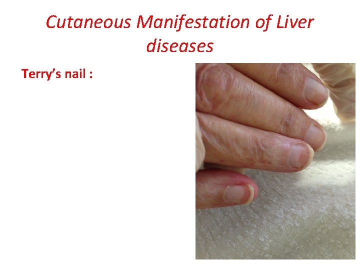Cutaneous Manifestation of Liver diseases Terry’s nail : 
