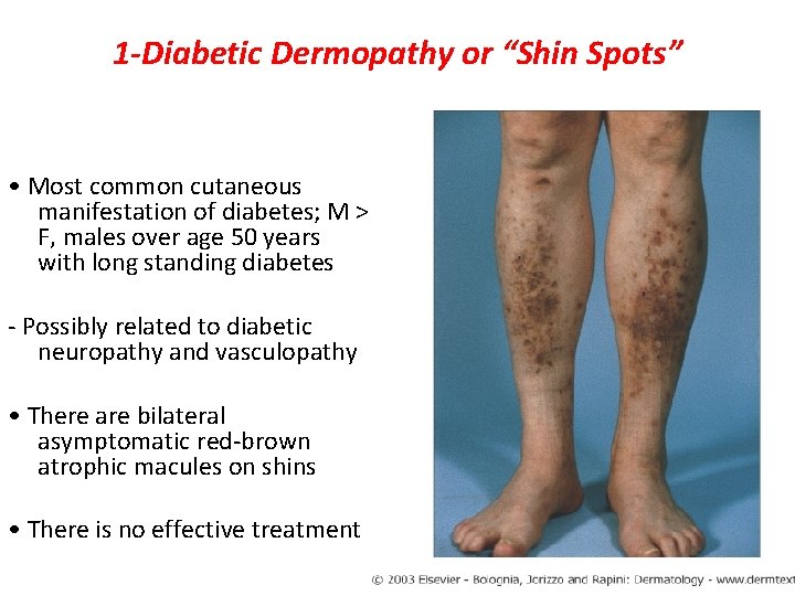 1 -Diabetic Dermopathy or “Shin Spots” • Most common cutaneous manifestation of diabetes; M