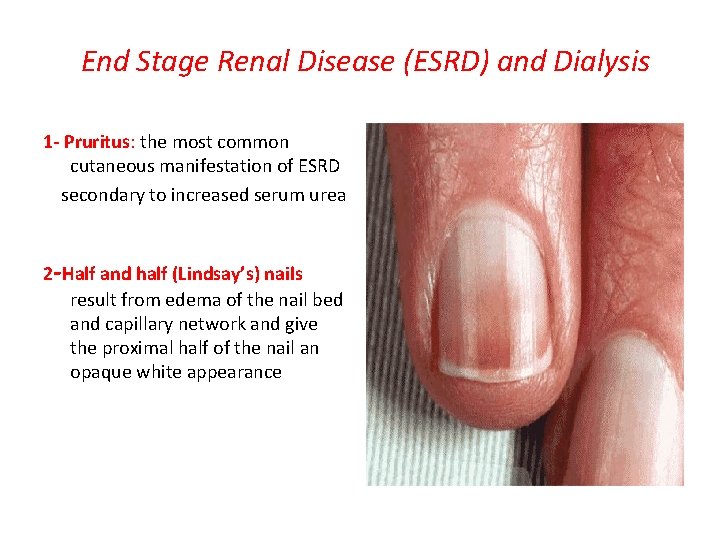 End Stage Renal Disease (ESRD) and Dialysis 1 - Pruritus: the most common cutaneous