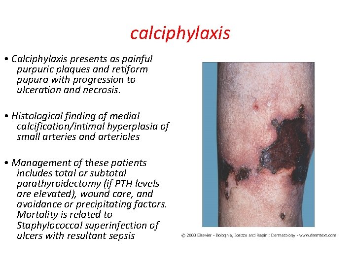 calciphylaxis • Calciphylaxis presents as painful purpuric plaques and retiform pupura with progression to