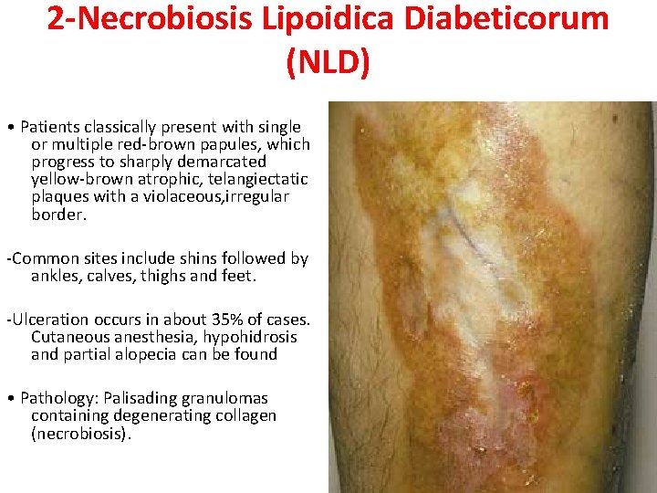 2 -Necrobiosis Lipoidica Diabeticorum (NLD) • Patients classically present with single or multiple red-brown