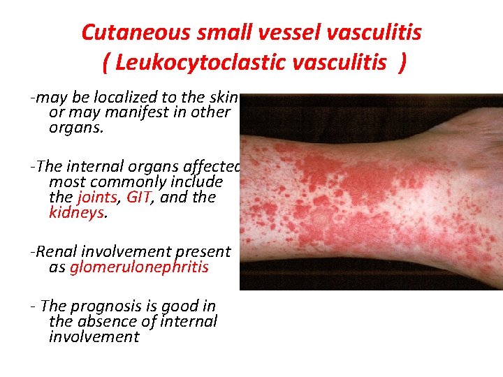 Cutaneous small vessel vasculitis ( Leukocytoclastic vasculitis ) -may be localized to the skin