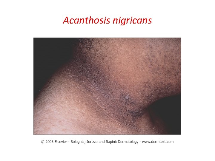 Acanthosis nigricans 