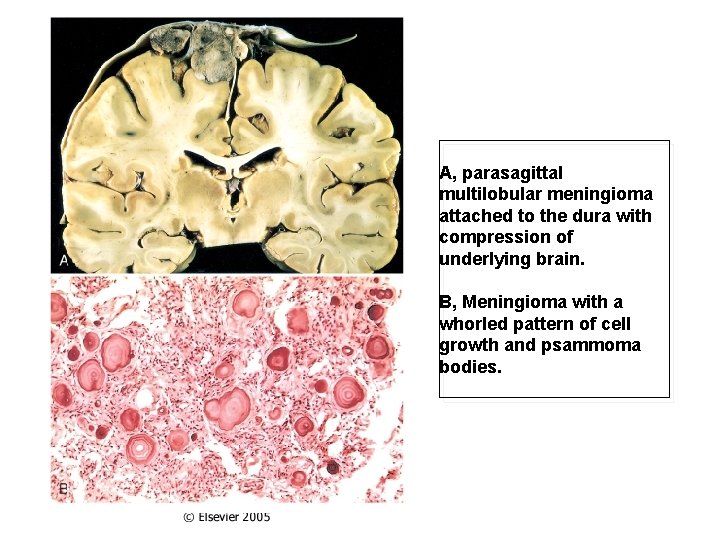A, parasagittal multilobular meningioma attached to the dura with compression of underlying brain. B,