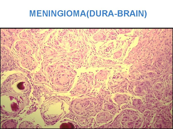 MENINGIOMA(DURA-BRAIN) 