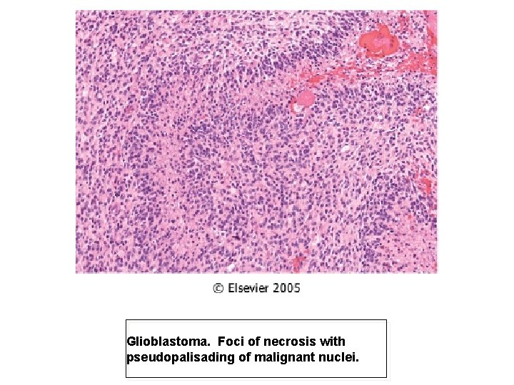 Glioblastoma. Foci of necrosis with pseudopalisading of malignant nuclei. 