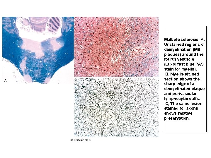 Multiple sclerosis. A, Unstained regions of demyelination (MS plaques) around the fourth ventricle (Luxol