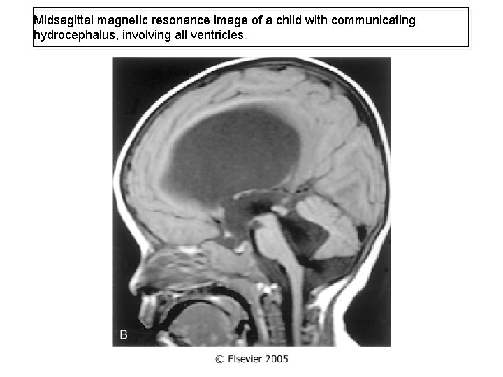 Midsagittal magnetic resonance image of a child with communicating hydrocephalus, involving all ventricles. 