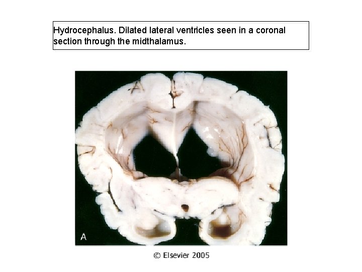 Hydrocephalus. Dilated lateral ventricles seen in a coronal section through the midthalamus. 