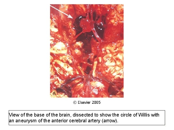 View of the base of the brain, dissected to show the circle of Willis