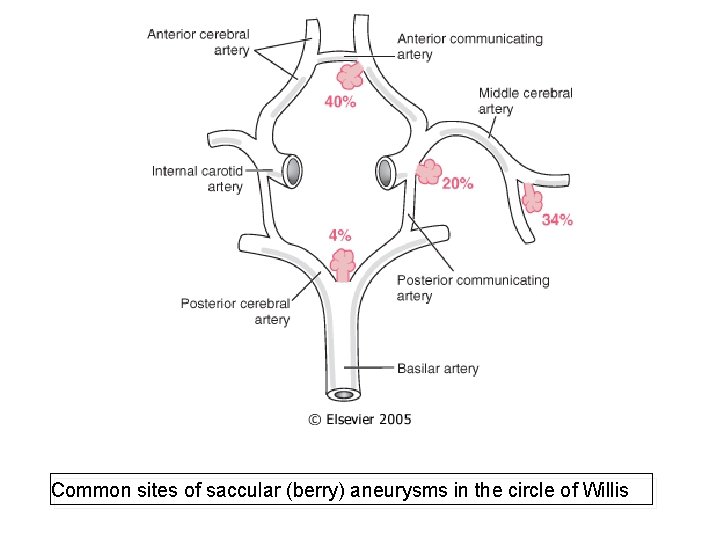 Common sites of saccular (berry) aneurysms in the circle of Willis 