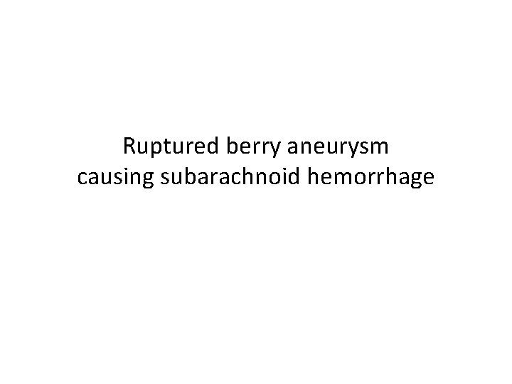 Ruptured berry aneurysm causing subarachnoid hemorrhage 