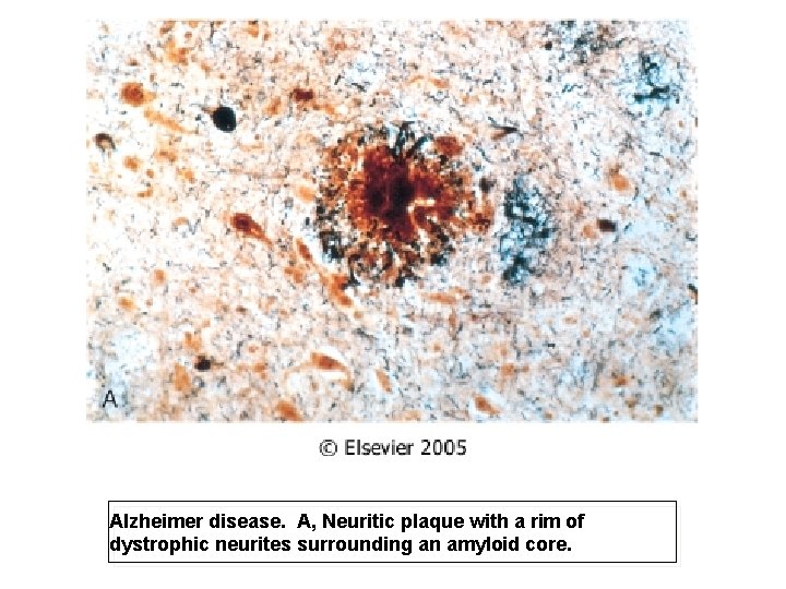 Alzheimer disease. A, Neuritic plaque with a rim of dystrophic neurites surrounding an amyloid