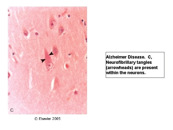 Alzheimer Disease. C, Neurofibrillary tangles (arrowheads) are present within the neurons. 