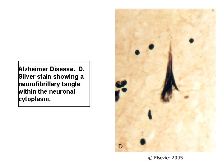 Alzheimer Disease. D, Silver stain showing a neurofibrillary tangle within the neuronal cytoplasm. 